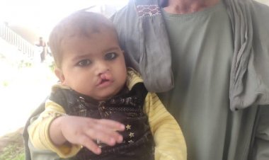 هلمند کي د لمُړي ځل لپاره د سل تنه  Cleft palate او Cleft lip and Cleft palate ماشومانو وړیا درمنله کيږي.